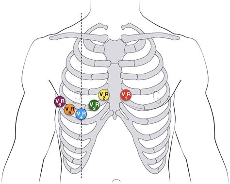 right sided precordial ecg.